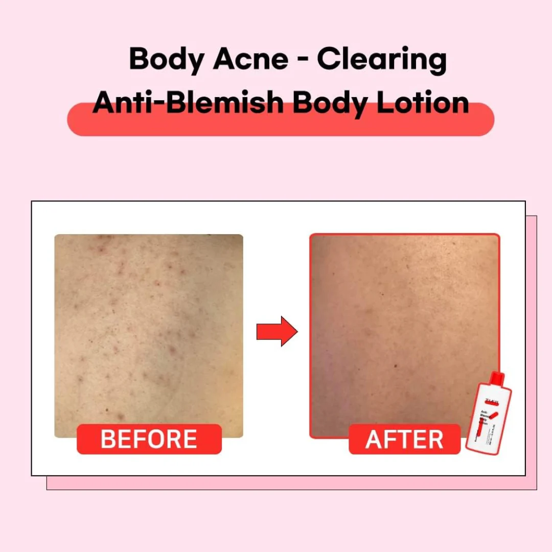 Anti Blemish Body Lotion Back & Chest - Image 5